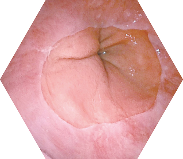 Endoscopic Viewing Angle