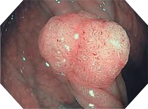 NBI (Narrow Band Imaging)